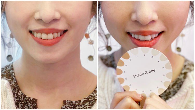 牙黃急救😬編輯實試家用藍光美白牙齒神器＋用後感！另推介2款高效去黃產品