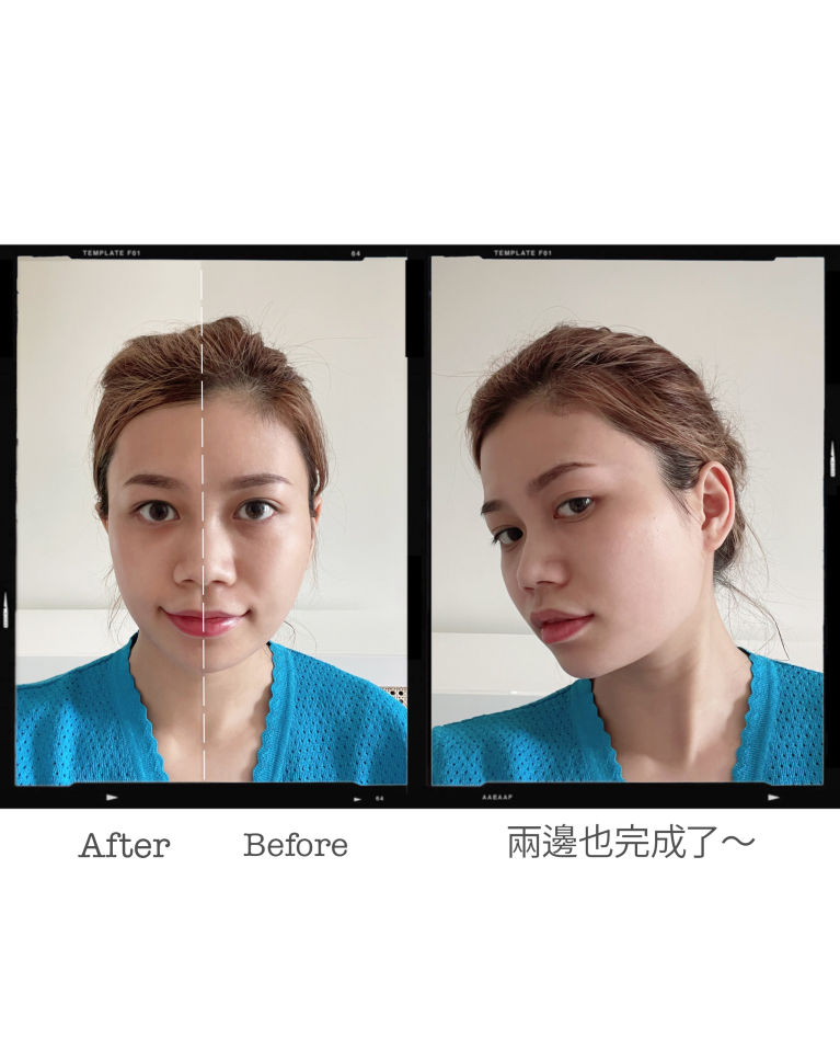 初次使用家用Hifu機