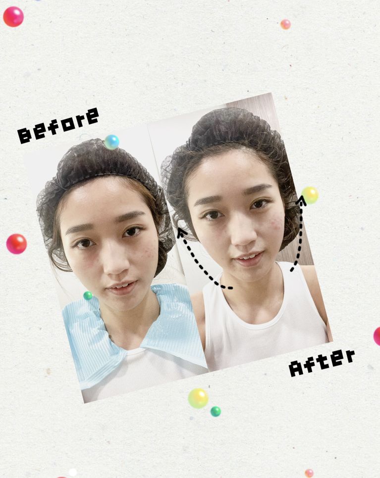 編輯實試人氣美容瘦身療程：Ultherapy 緊緻提拉、BTL 隔空溶脂、徒手小顏矯正｜真實效果分享